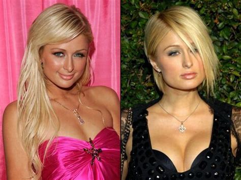 Paris Hilton Plastic Surgery Before and After