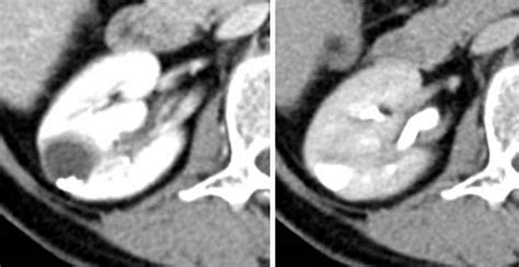 Calyceal diverticulum – Radiology Cases