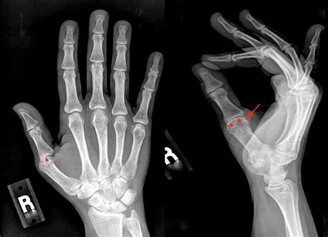 MR Imaging of Rheumatoid Arthritis - Radsource