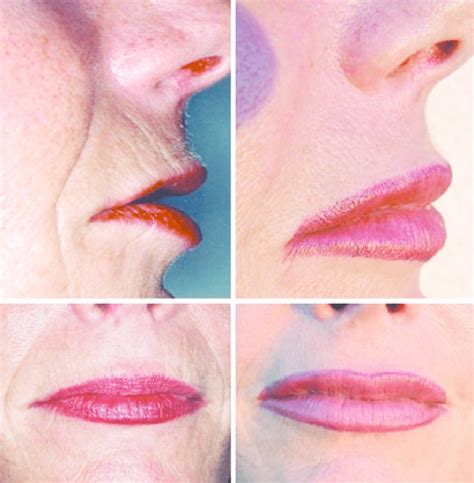 10. Filling the vermilion border in an elderly lip gives pouting back... | Download Scientific ...