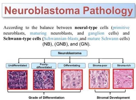 Pin en Neuroblastoma