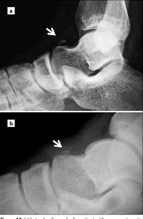 Figure 14 from The Accessory Ossicles of the Foot and Ankle; a Diagnostic Pitfall in Emergency ...