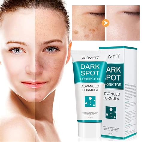 Buy Dark Spot Remover for Face, Dark Spot Corrector Cream, Fade Out The Skin Black Precipitate ...