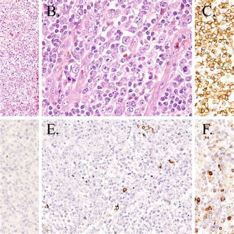 Figure3.Inguinal lymph node biopsy. Lymph node biopsy shows loss of... | Download Scientific Diagram