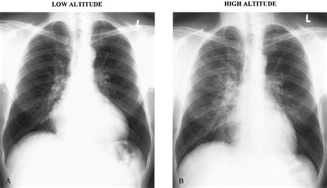 Pulmonary Edema Gross