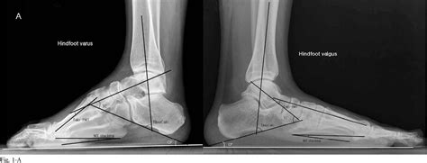 Figure 1 from Reliability and validity of radiographic measurements in hindfoot varus and valgus ...