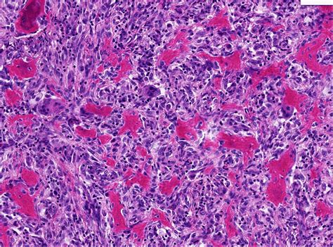 Osteosarcoma Histology