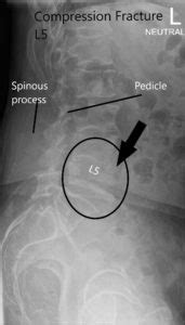 Case Study: L5 Vertebral Pathological Fracture Management