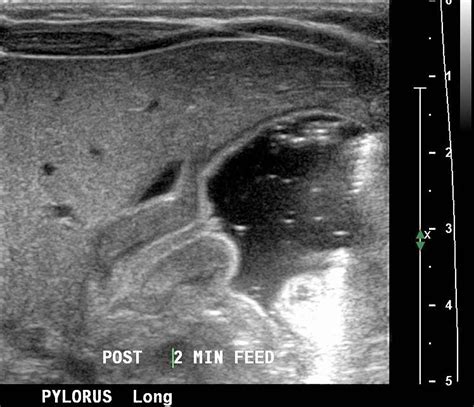 Pyloric stenosis ultrasound - wikidoc