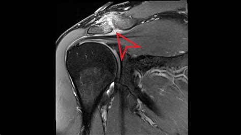 Acromioclavicular Joint Mri | The Best Porn Website