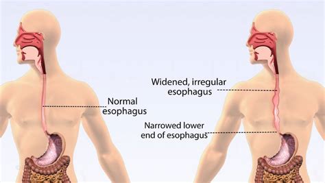 Achalasia Treatment (With/without Surgery)- Dr. Samrat Jankar