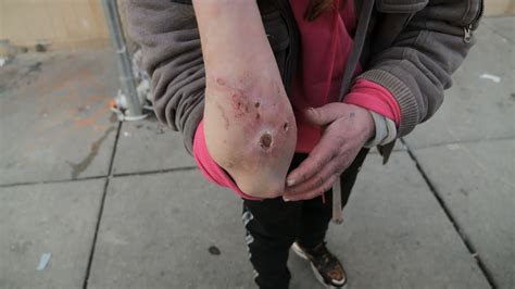 'Tranq dope': A new drug is rotting people's skin and causing horror on US streets | US News ...