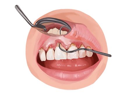 Scaling and root planing: procedure, effectiveness, and risks