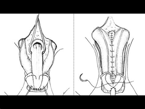 Epispadias Repair @Pediatric-Urologist - YouTube