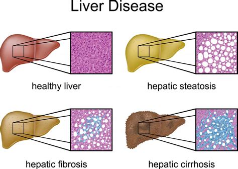 What is the Caudate Lobe? (with pictures)