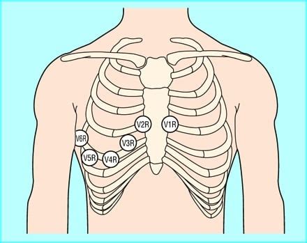 Paucis Verbis: Right and posterior EKG leads