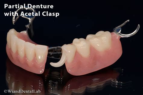 Partial Denture with Acetal Clasp