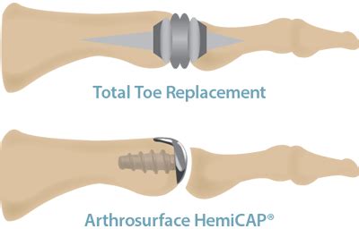 Of Large Toe Joint Replacement