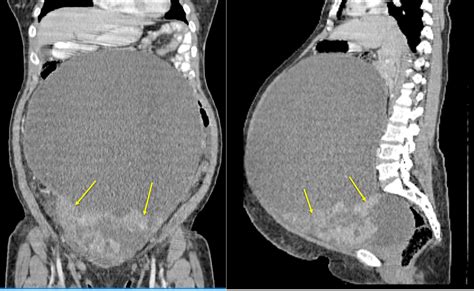 Ovarian mucinous cystadenoma of borderline malignancy – Radiology Cases