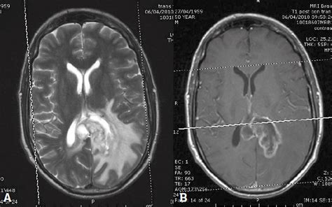 RACGP - MRI brain imaging