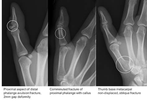 Thumb fracture