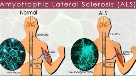 ALS – Amyotrophic Lateral Sclerosis – Lou Gehrig’s Disease ⋆ Santa ...