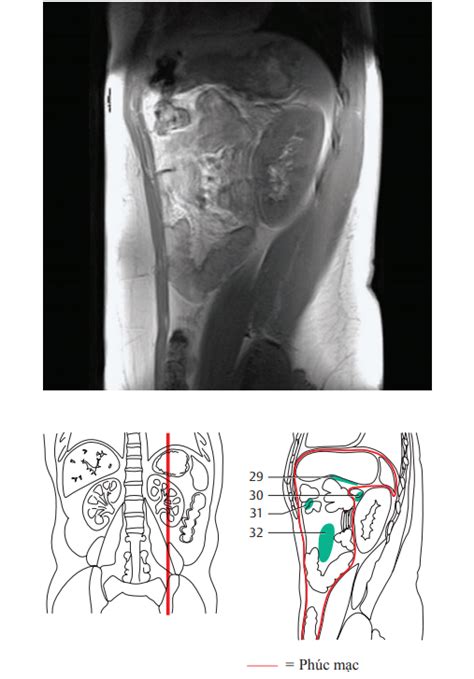 [CT-MRI Số 25] MRI Bụng (Mặt phẳng đứng dọc) – Y khoa