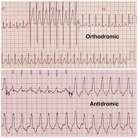 Atrioventricular Reentrant Reciprocal Tachycardia AVRT Cardiac Arrhythmias Explained | Cardiac ...