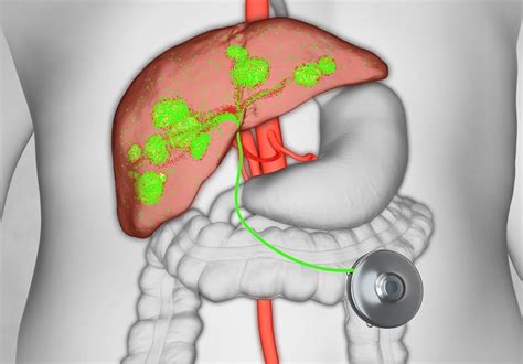 Hepatic-arterial Chemotherapy The Lancet Oncology, 52% OFF