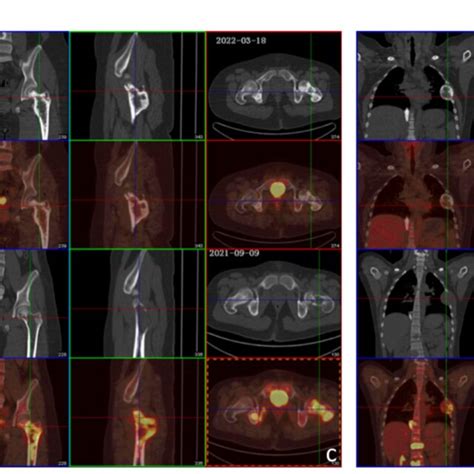 a) Postoperative pathology of primary skull tumor showed that it was... | Download Scientific ...