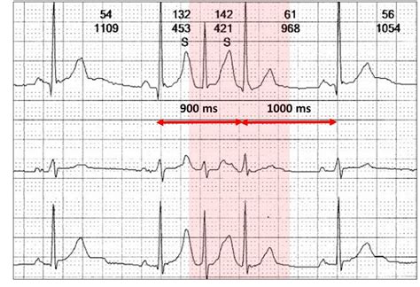 Exotic atrial ectopy part two - Resources