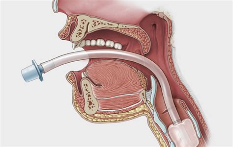 Intubation - Clark Medical Media