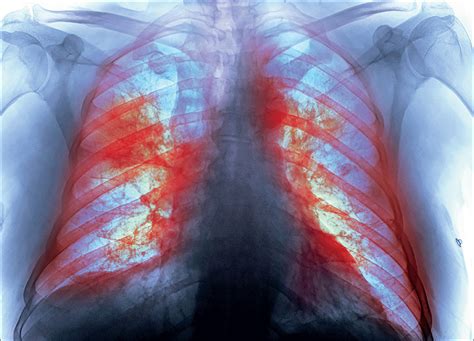 Pathophysiology of COVID-19-associated acute respiratory distress ...