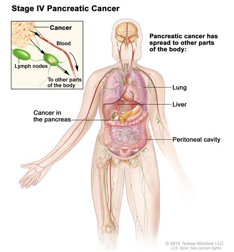 Cancer In The Lymph Nodes And Liver - CancerWalls