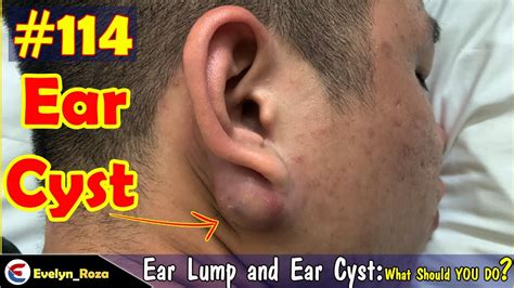 Removal Ear Lump and Ear Cyst | Acne Million views | Acne Treament #114 - YouTube