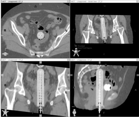 Brachytherapy planning CT scan images in 3 planes show the cylinder ...