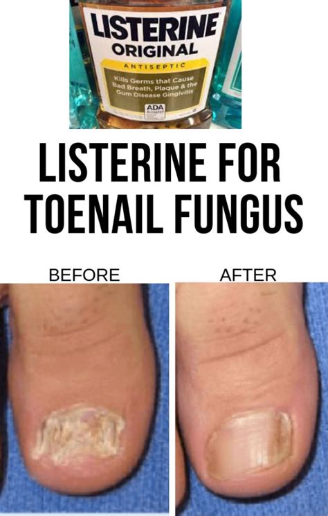 Best Listerine for Toenail Fungus in 2022 and Beyond | Toenail fungus ...