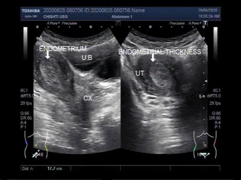 [36+] Uterine Cancer Ultrasound Endometrial Hyperplasia