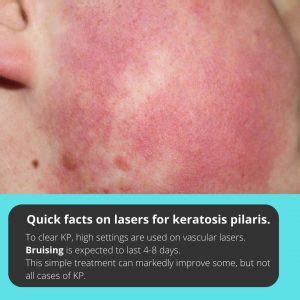 Best Keratosis Pilaris Treatment In Australia | Dr Davin Lim