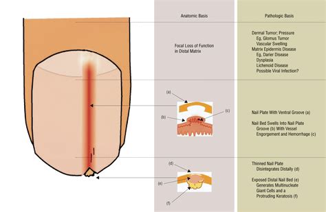 Localized Longitudinal Erythronychia: Diagnostic Significance and ...