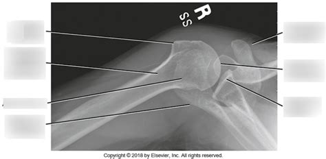 DIAGRAM - Inferosuperior Axial Shoulder X-Ray - 2018 Diagram | Quizlet