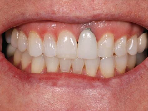 Are Titanium Dental Implants Safe - Metal Allergies