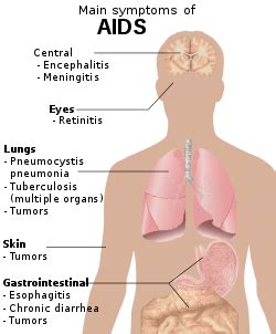 Signs and symptoms of HIV/AIDS - WikiProjectMed