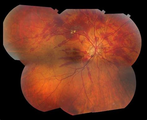 Moran CORE | Fundus Photography of Traumatic Choroid Rupture with ...