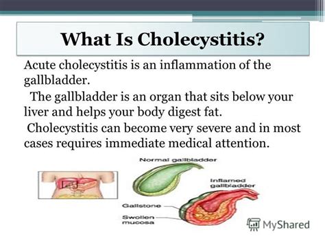 Acute Cholecystitis