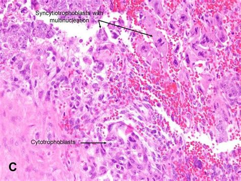 Biphasic choriocarcinoma: - syncytiotrophoblast: large, multinucleated ...