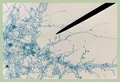 Fun With Microbiology (What's Buggin' You?): Sporothrix schenckii: