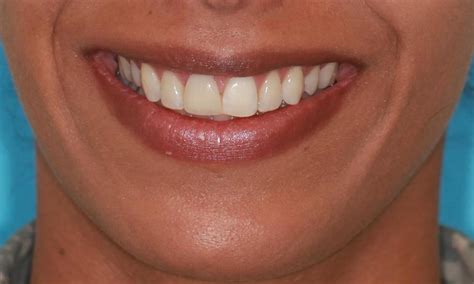 Missing front tooth Before & After Photos | Seabrook TX