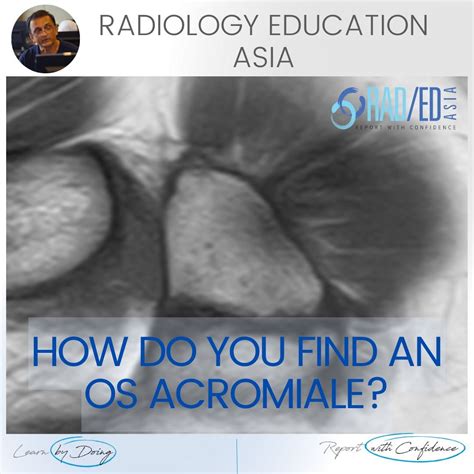 OS ACROMIAL SHOULDER MRI RADIOLOGY (VIDEO) - Radedasia