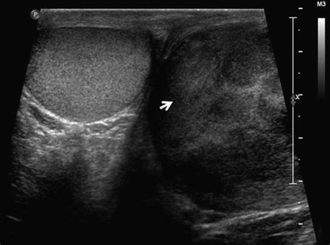 Scrotal Mass | Basicmedical Key